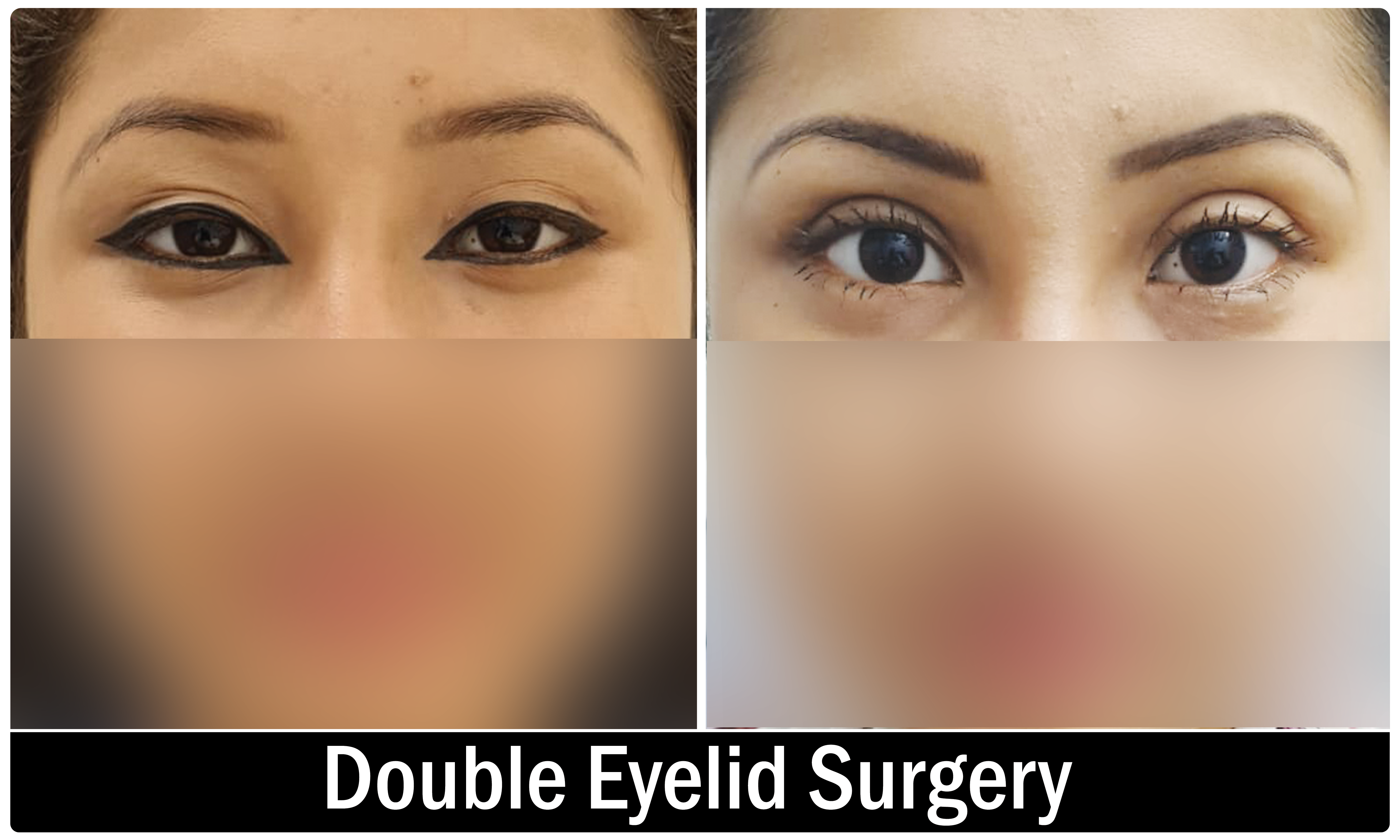 Eyelid Surgery KOQ10